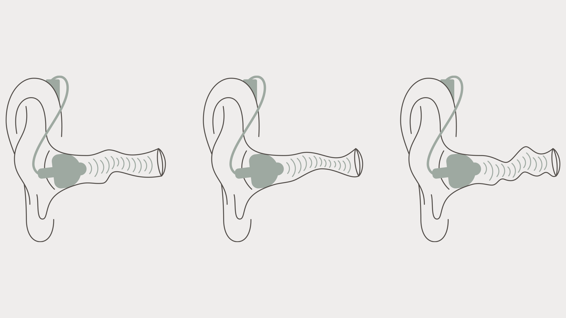 Visualization of how Widex hearing aid tips fit in different ear canals